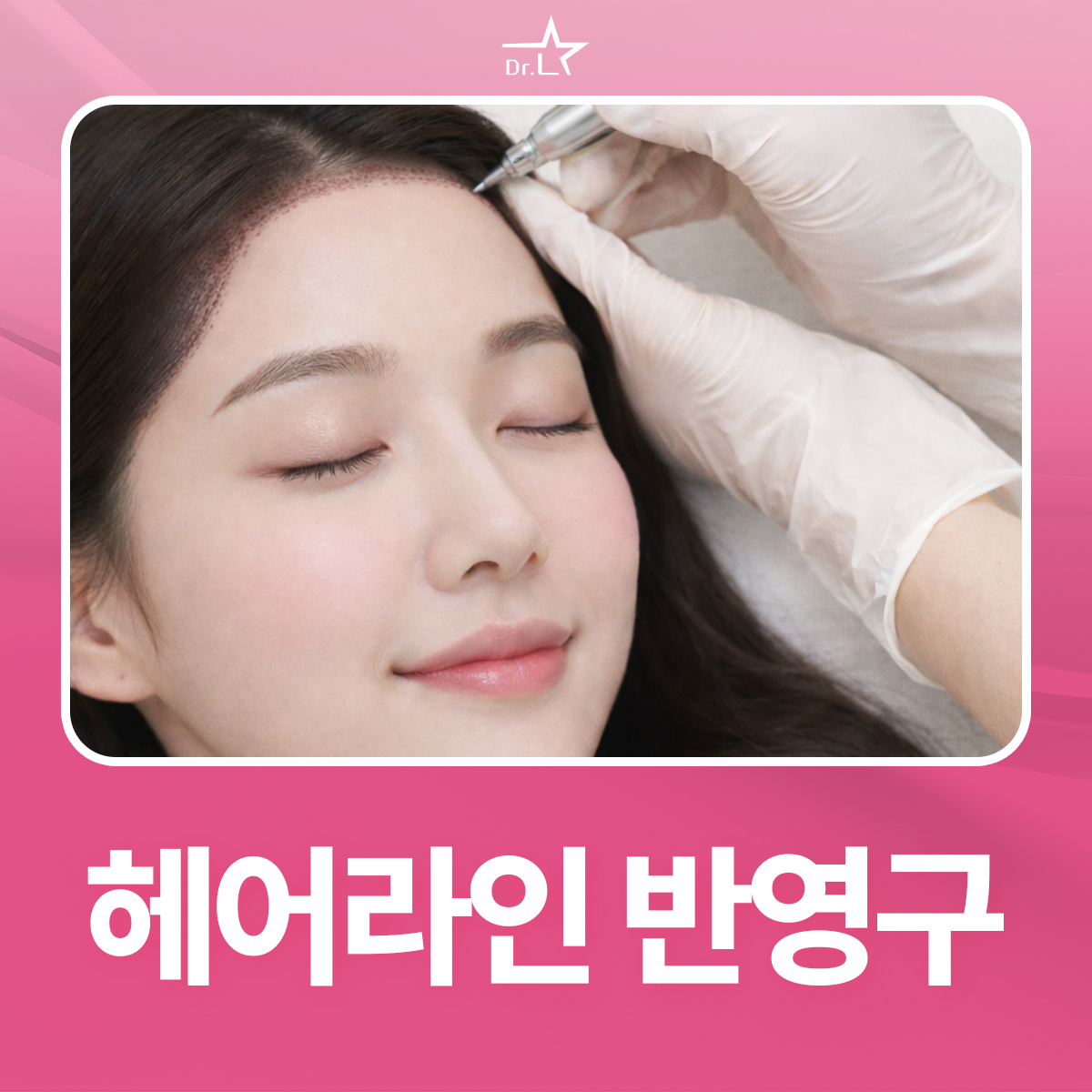 헤어라인 반영구